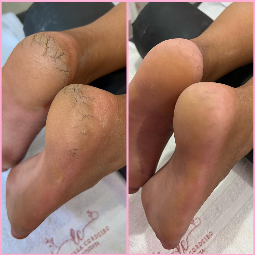 Resultado Spa dos Pés